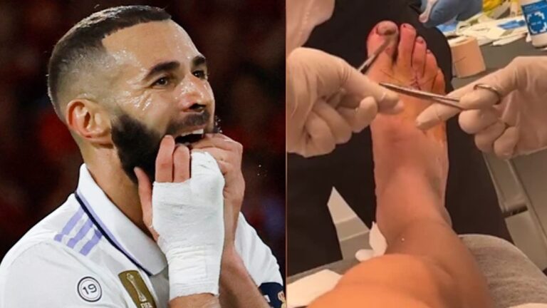 Impactante imagen del pie de Benzema: Jugó con un corte que necesitó 5 puntos de sutura