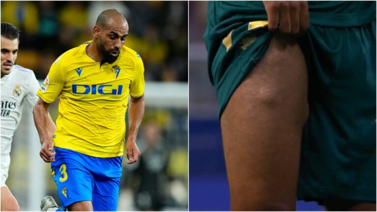 La extraña lesión de Fali, jugador del Cádiz ¿Qué le pasó a su pierna?