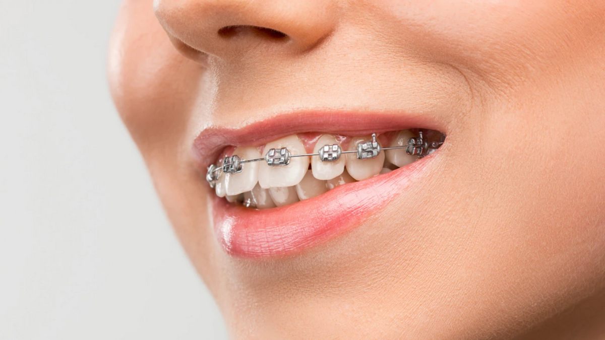 ¿Cómo limpiar tus dientes si tienes brákets? Consejos para lograr una