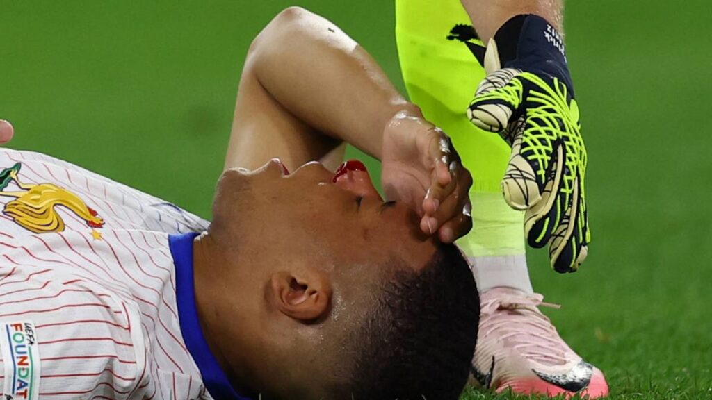La lesión de Mbappé en la nariz | Reuters