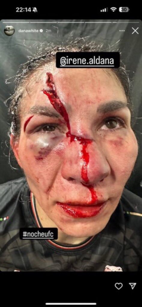 ¡De terror! Así quedó el rostro de Irene Aldana tras el cabezazo de Norma Dumont en la Noche UFC