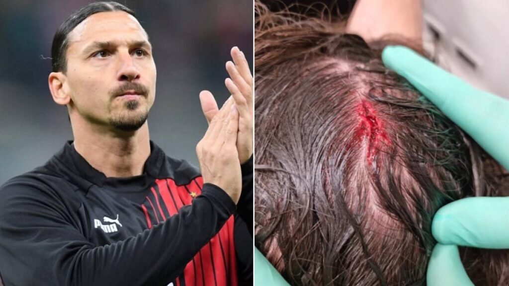 Zlatan Ibrahimovic y una enigmática herida en la cabeza