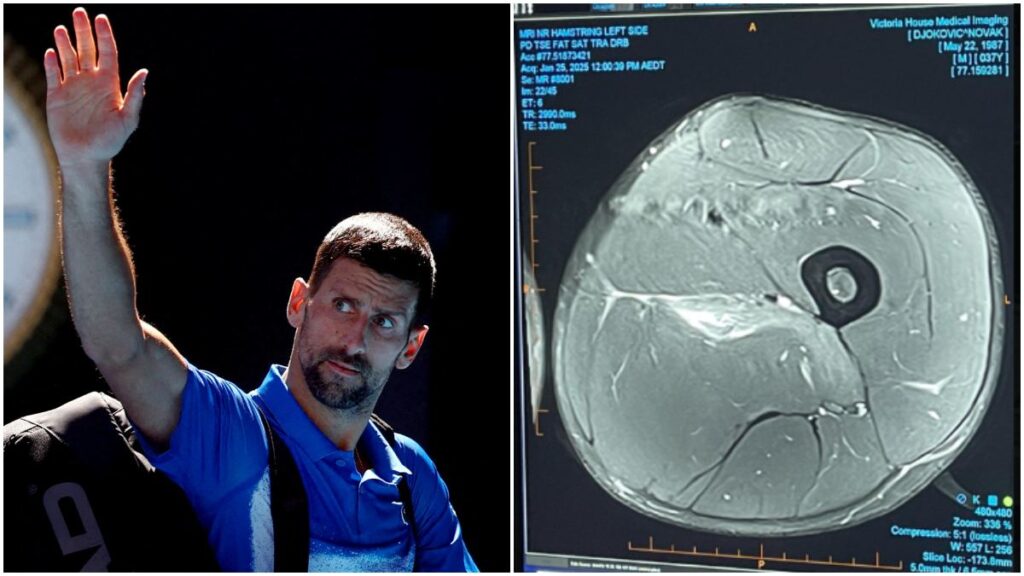 Djokovic publicó la resonancia magnética que revela la lesión en los isquiotibiales que lo hizo retirarse del Australian Open.